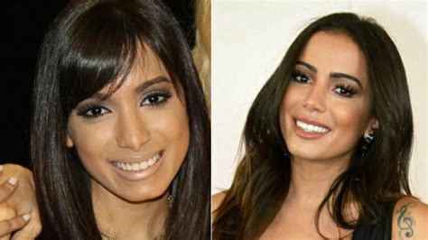 does anitta have a bbl|anitta cosmetic surgery.